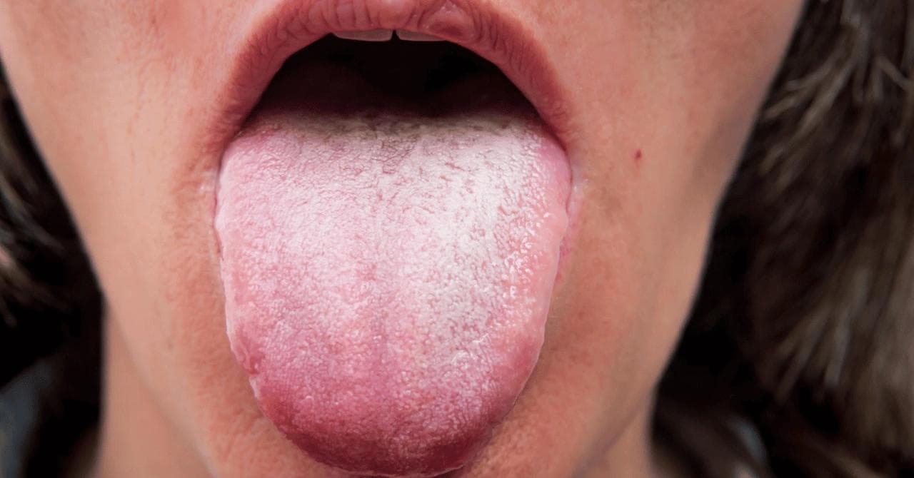 White Tongue on Ozempic