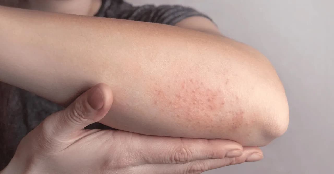 Three Mechanisms Behind Zepbound-Related Itching